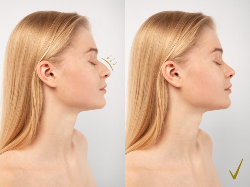 Ventajas de la rinoplastia ultrasónica